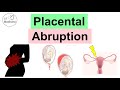 Placental Abruption (Abruptio Placentae) Risk Factors, Symptoms, Complications, Diagnosis, Treatment