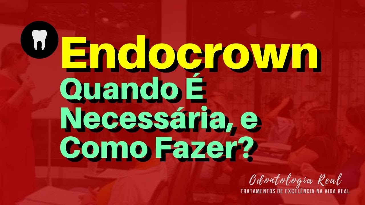 Aula 42 - Endocrown: Quando É Necessária, e Como Fazer?