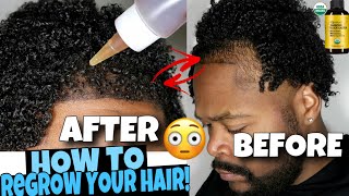 HOW TO GROW Your HAIRLINE BACK FAST!!