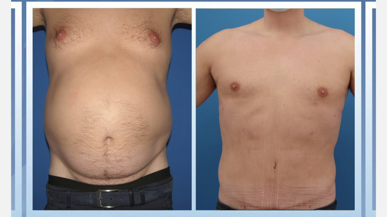 Testimonio de Abdominoplastia y Liposucción Hombres | Experiencia Personal