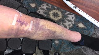 Crazy Bruising! 5 Days Post ACL Surgery!