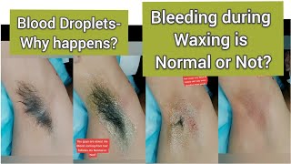 Bleeding  Droplet from Hair Follicles is Normal or Not | Why Happen | Full Growth Underarms waxing