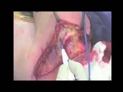 Osteosarcoma Resection Of The Humerus Proximal End - Part 2/6