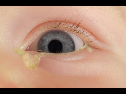 How to treat a sticky eye in a baby