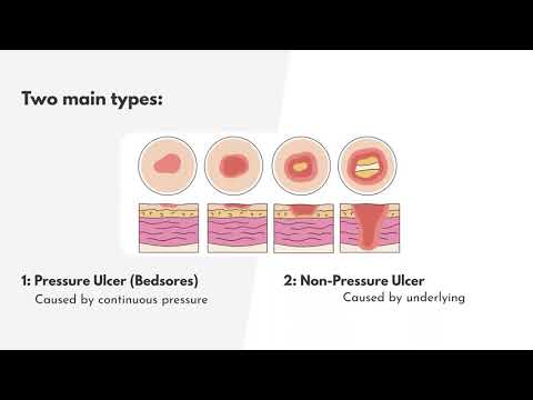 ICD-10-CM Coding for Skin Ulcer-L Codes - MEDESUN Academy