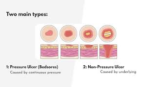 ICD-10-CM Coding for Skin Ulcer-L Codes - MEDESUN Academy