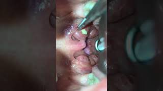 Tonsil stone removal