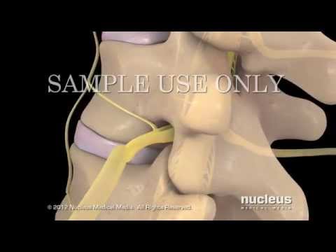 Lesiones de disco lumbar y tratamiento
