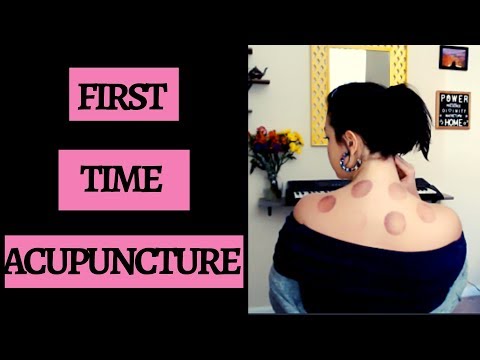 Does Acupuncture Hurt? (Honest Review: MY FIRST TIME!)