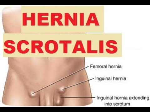 , title : 'Hernia Scrotalis | Hernia | Sistem Pencernaan | Penjelasan Singkat'