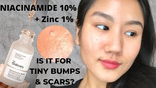 The Ordinary NIACINAMIDE + ZINC FOR TINY BUMPS & ACNE SCARS (4 weeks REVIEW) Fungal Acne Safe