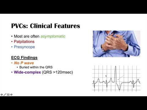 A Common Cause of Palpitations | Premature Ventricular Contractions (PVCs): Triggers & Symptoms