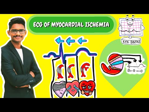 How to detect the calm(Ischemia) before the storm(Myocardial Infarction) from an ECG ?! | MI ECG