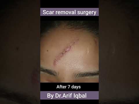 Face Scar surgery @DesignerDoctor #scarsurgery #scartreatment #skin #skintreatment