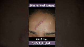 Face Scar surgery @DesignerDoctor #scarsurgery #scartreatment #skin #skintreatment