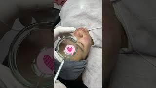 Acne Peel Treatment
