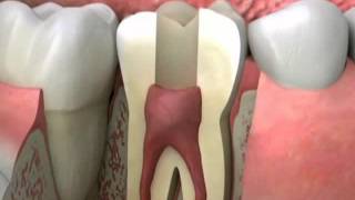 preview picture of video 'Root Canal Procedure Demystified by Cherry Hill Dental in Columbia MO'