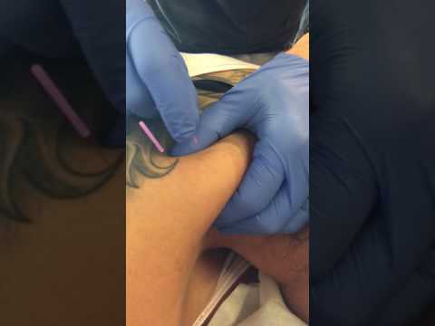 Dry Needling at The Fitness Lab