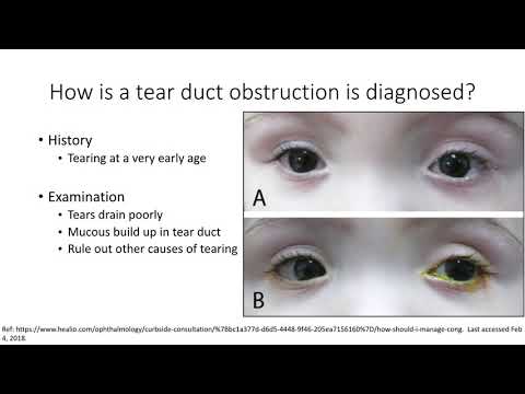 AAPOS: Nasolacrimal Duct Obstruction