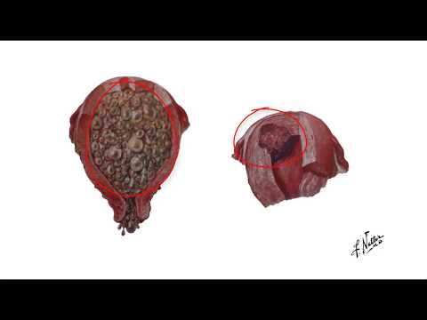 Ultrassonografia na doença trofoblástica gestacional