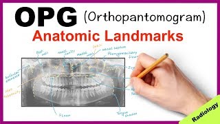 Orthopantomogram (OPG) Anatomical Landmarks - Radi