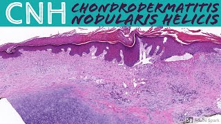 Chondrodermatitis nodularis helicis (CNH)