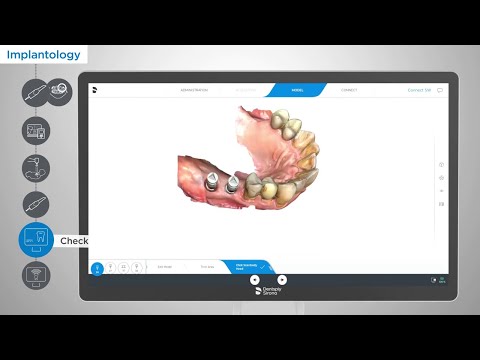 Streamlining Excellence: Implantology Workflow with Primescan