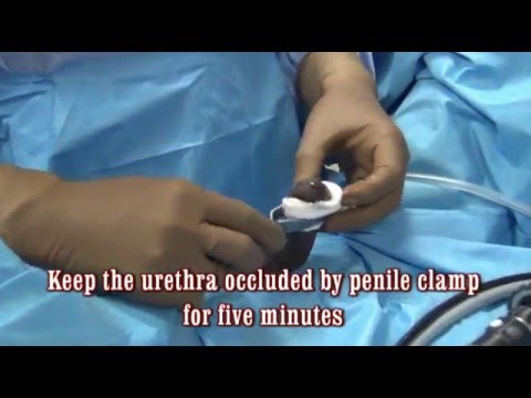 Cistoscopia - anestesia