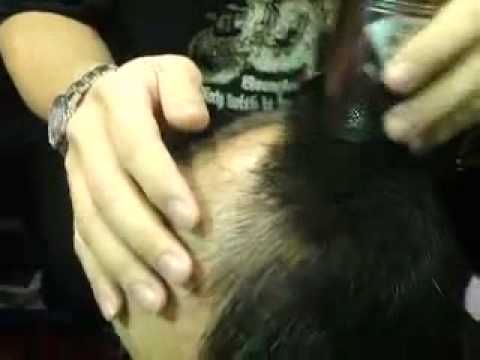 pourquoi la calvitie