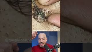Monsterous ingrown hair😱 #ingrownhair #doctorreacts