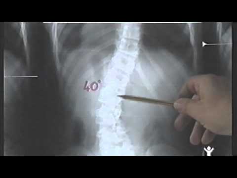 Di malattia degenerativa del disco cervicale fa male al cuore Colonna vertebrale trattamento violazione Mosca
