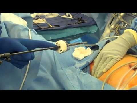 Szycie laparoskopowe- wprowadzanie dużej igły przez małe nacięcie