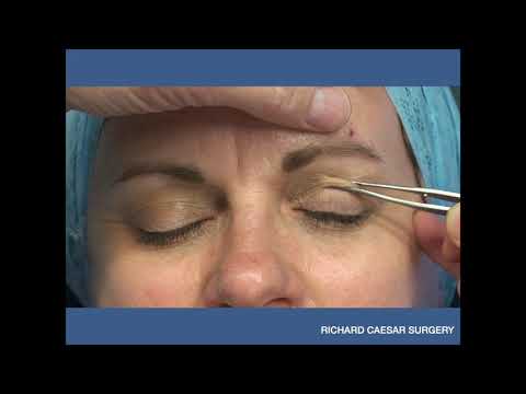 Tutorial - Marking the Upper Lid Blepharoplasty
