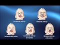 Cleft Diagnosis Pediatric Playbook Boston Children S Hospital