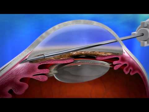 XEN Glaucoma Implant