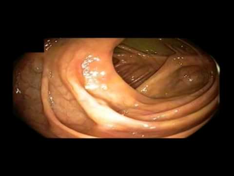 Orificio apendicular normal, ciego y válvula ileocecal