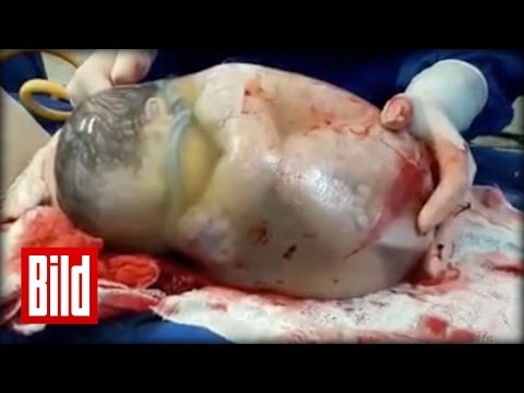 , title : 'Baby in Fruchtblase geboren - Hammer Video'