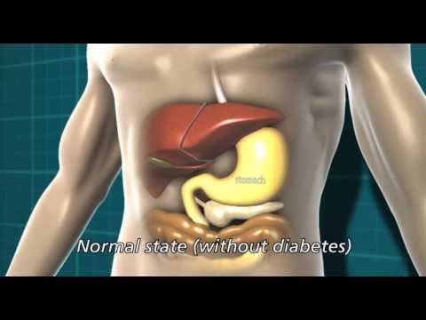 Cukor diabeteste 2 típusú kezelés inzulinfüggő