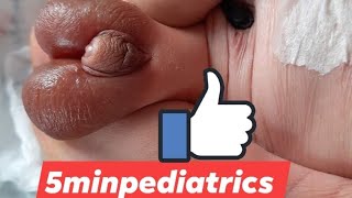 Ambiguous genitalia #5minpediatrics