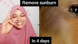 How to completely get rid of sunburn forever in just 4 days |fast action