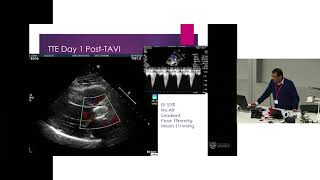 TAVI for Bicuspid Aortic Valves – Dr Rohan Bhagwandeen
