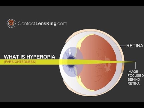 What is Farsightedness and Hyperopia
