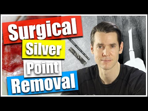 Silver Point Removed Surgically