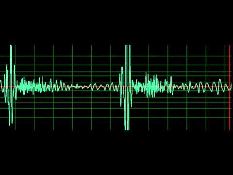 Mitral Regurgitation- slow