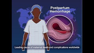 Early Detection and Treatment of Postpartum Hemorrhage | NEJM