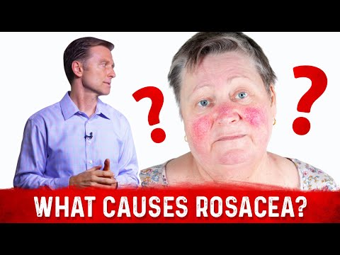 Dr. Berg’s Opinion on Causes of Rosacea and Its Treatment