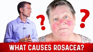 Dr. Berg’s Opinion on Causes of Rosacea and Its Treatment