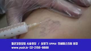 실핏줄 제거 시술(혈관경화요법)
