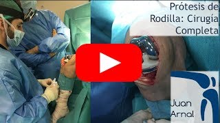 Protesis de Rodilla: Cirugía completa