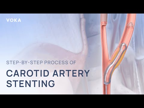 Step-by-step process of carotid artery stenting